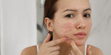 Winter Acne